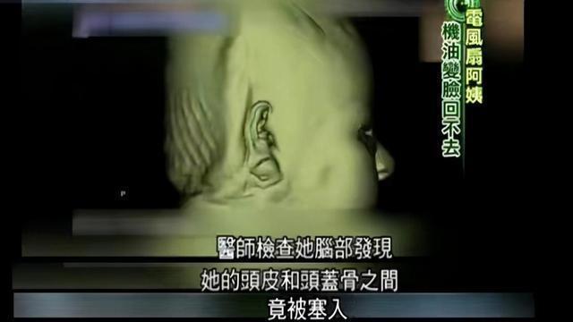 整容上瘾韩慧景：把脸整成电风扇自行注射食用油代价惨痛(图14)